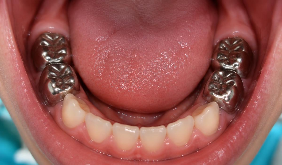 Close-up of a child's lower teeth with four shiny stainless steel crowns on the back baby molars.